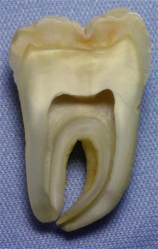 Bio mineral:  Human mandibular first molar.  Ca10 (PO4)6 (OH)2  and  Ca10 (PO4)6 (OH1.8 F0.2) (Author: Turbo)