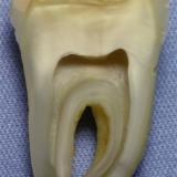 Bio mineral:  Human mandibular first molar.  Ca10 (PO4)6 (OH)2  and  Ca10 (PO4)6 (OH1.8 F0.2) (Author: Turbo)